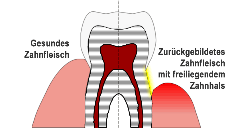 Vergleich von am Zahn eng anliegendem gesunden Zahnfleisch und entzündetem Zahnfleisch, das zu freiliegenden Zahnhälsen führt.