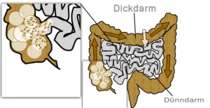 Dünndarmfehlbesiedlung